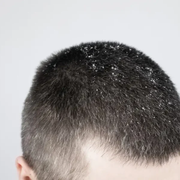 dandruff on man's hair