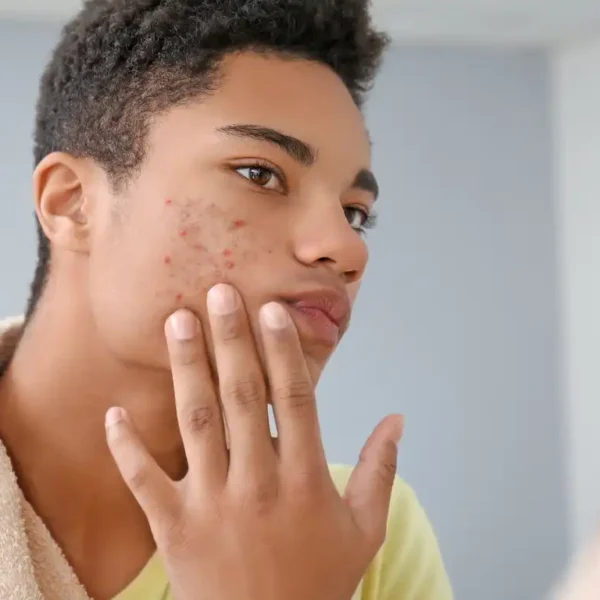 Teenager with acne problem