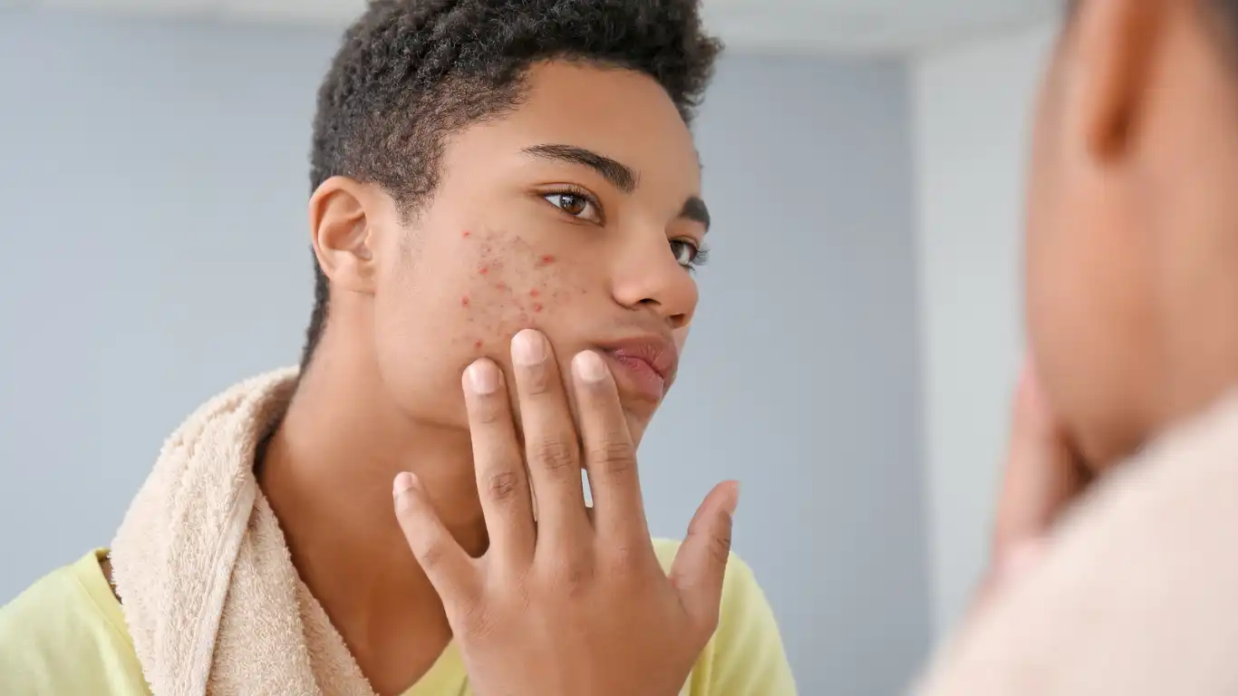 Teenager with acne problem