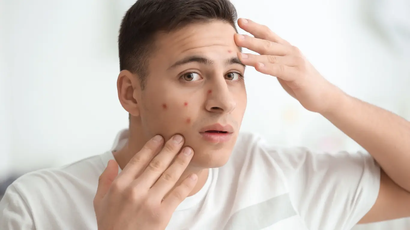 Young man with acne problem